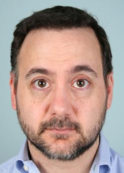 After Hair Transplant&nbsp;Front